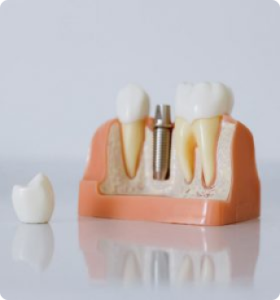 Dentures and over dentures